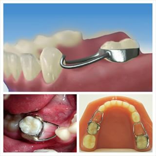 hàm giữ khoảng một bên