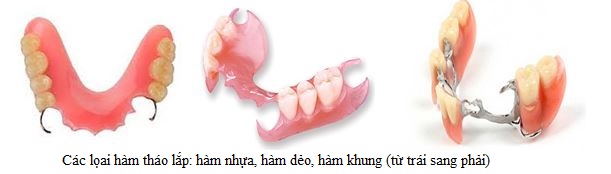 các loại phục hình tháo lắp