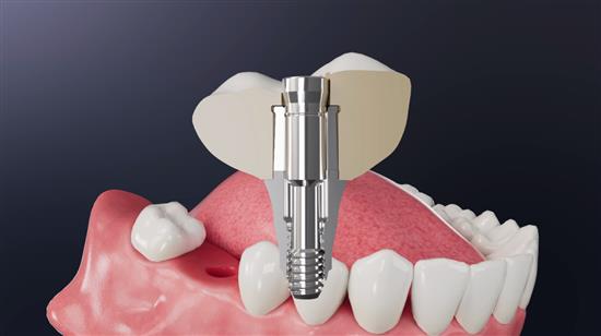 masterfix-ket-noi-phuc-hinh-va-tru-implant-khong-can-chat-gan-ban-da-thu-chua