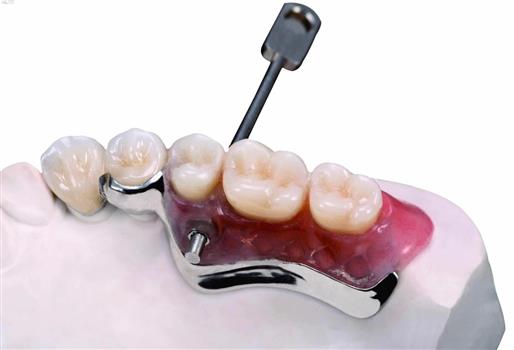 ham-khung-lien-ket-mac-cai-bam-mk1-la-mot-trong-nhung-giai-phap-toi-uu-nhat-danh-cho-nhung-nguoi-mat-rang-trong-cung