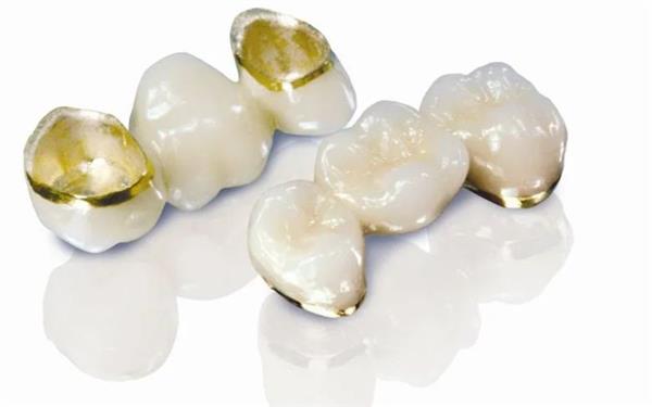 Răng Sứ Kim Loại Quý - Ceramic Gold Crown